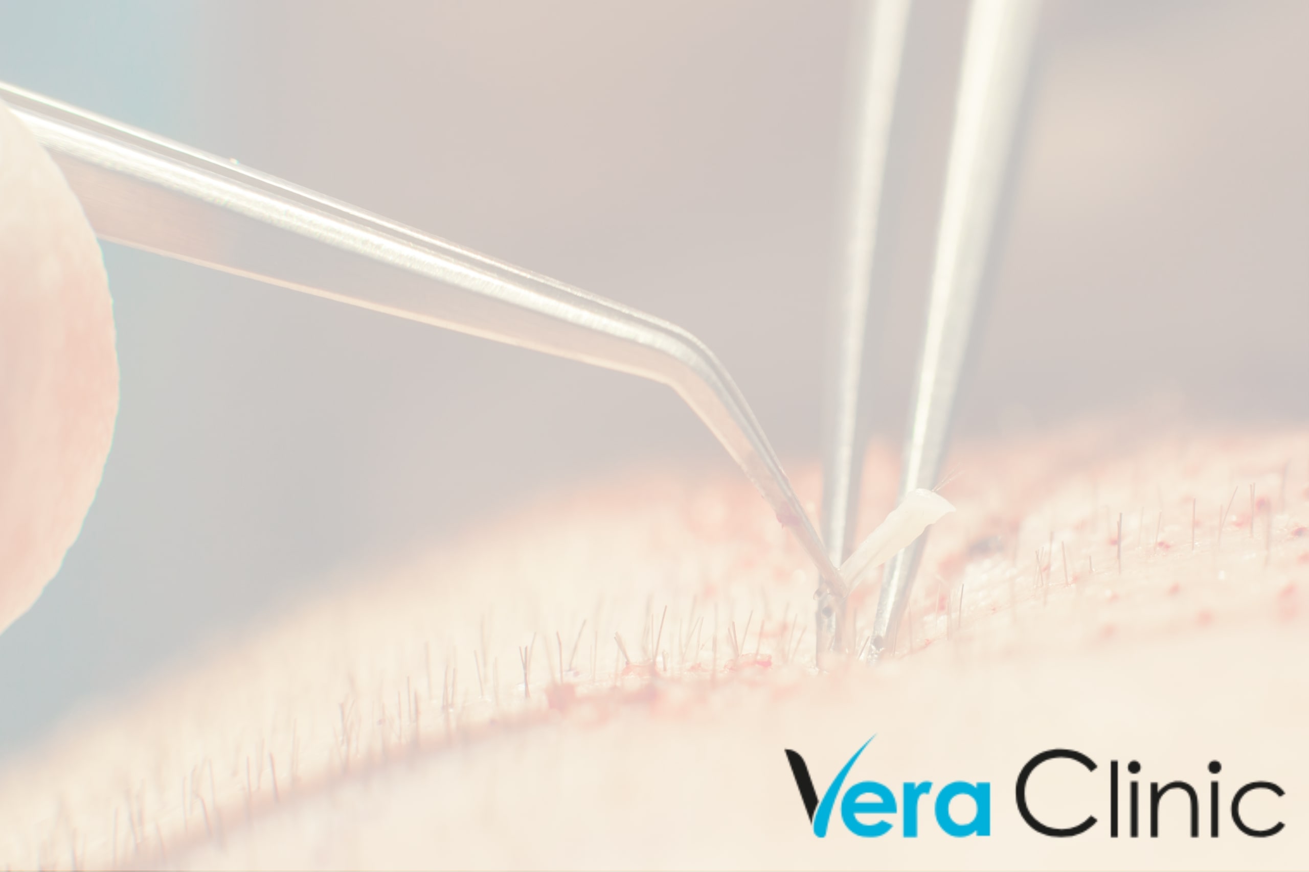What Is A Hair Graft?